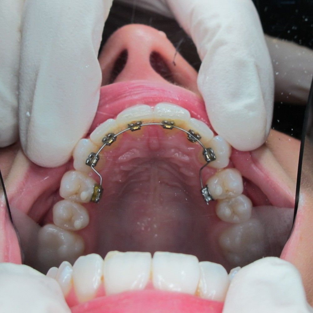 Dentistry On The Clyde | Behind Teeth Braces
