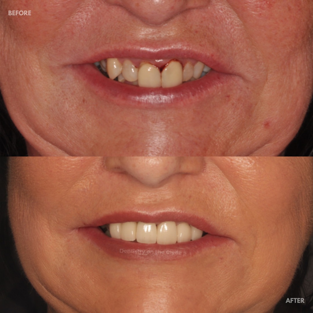 Dentistry On The Clyde | Dental Implants Gourock Replace Missing Teeth Dental Implants Treatment