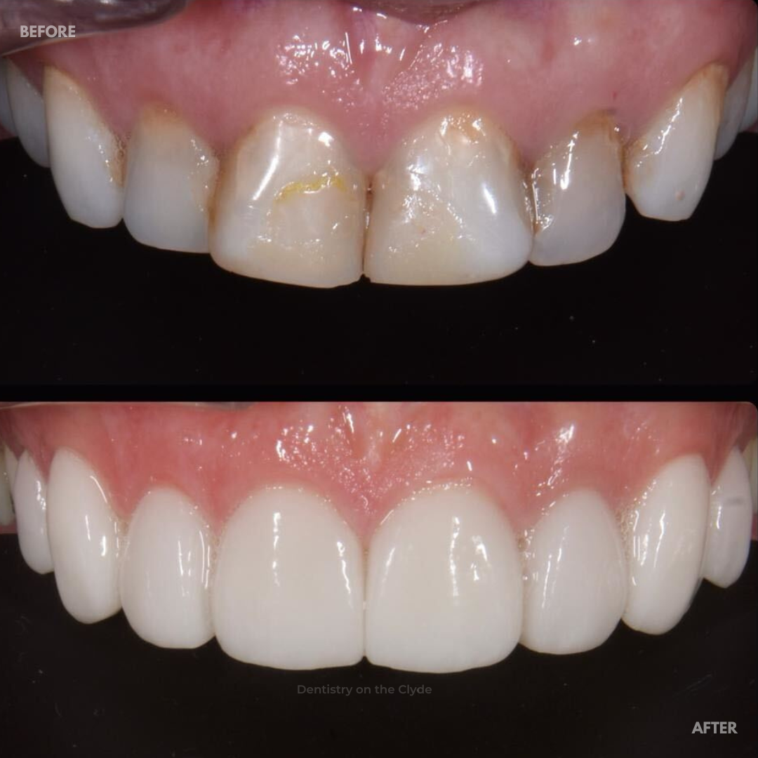 Dentistry On The Clyde | Smile Makeovers Before and after treatment at Dentistry On The Clyde