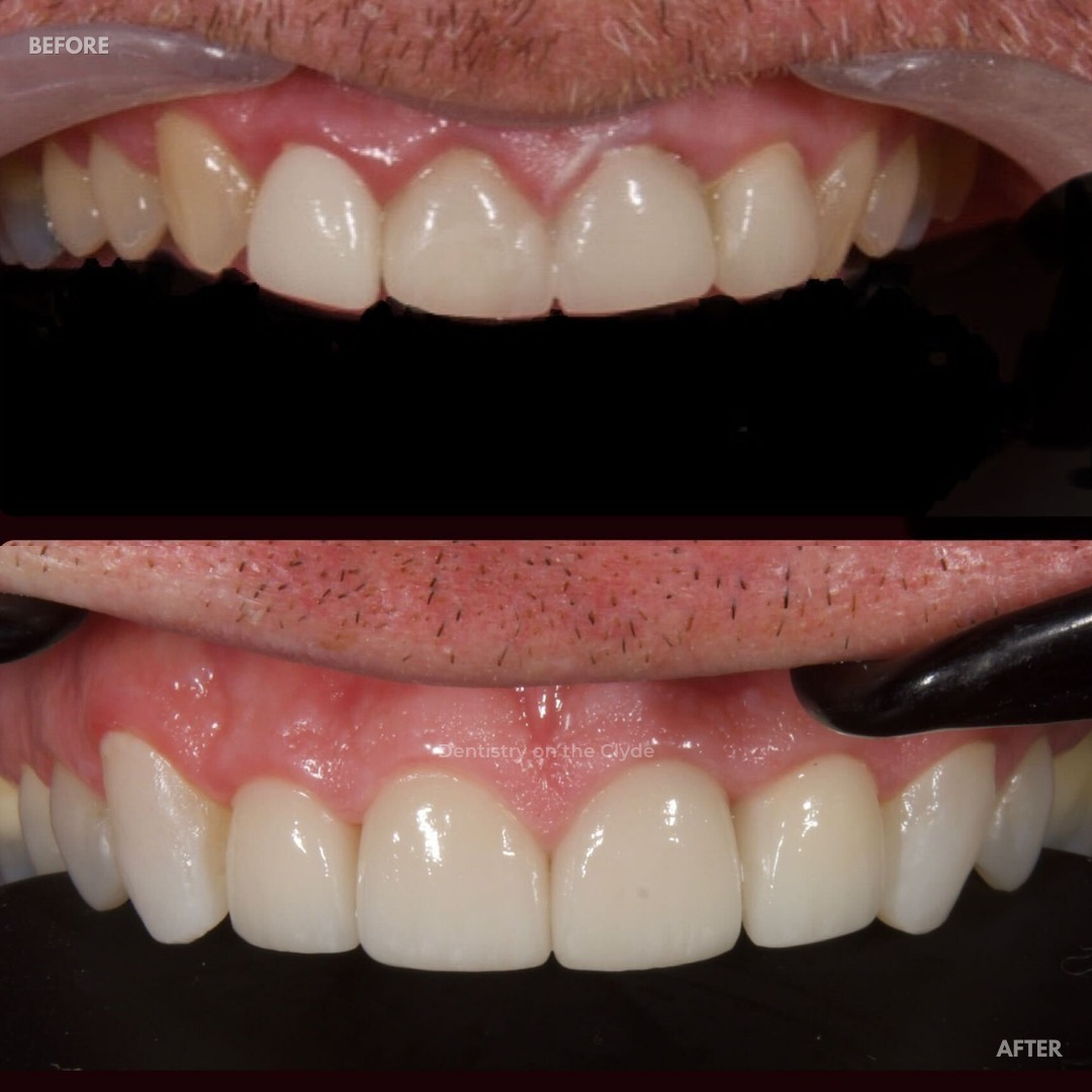 Dentistry On The Clyde | Smile Makeovers Before and after treatment at Dentistry On The Clyde