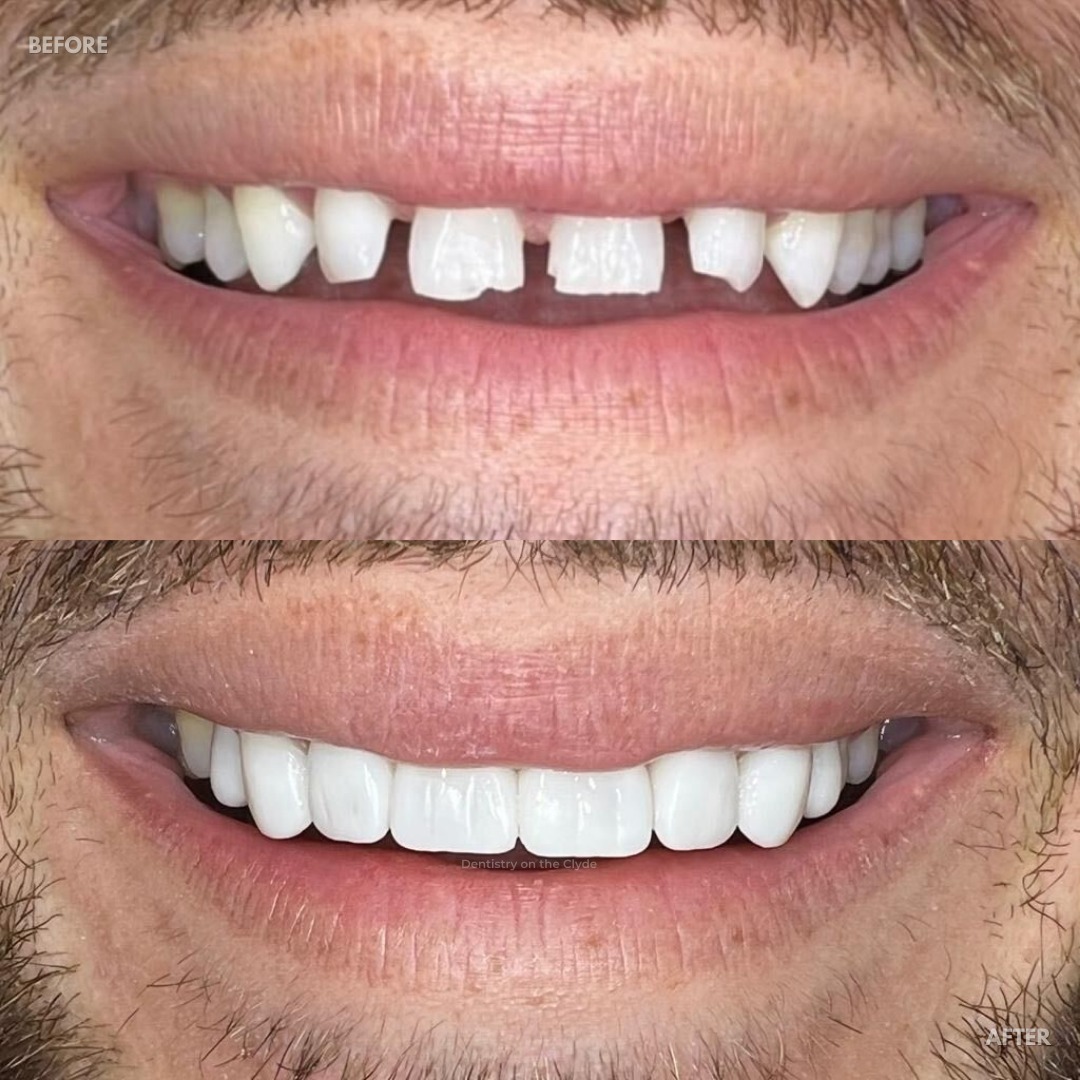 Dentistry On The Clyde | Smile Makeovers Before and after treatment at Dentistry On The Clyde