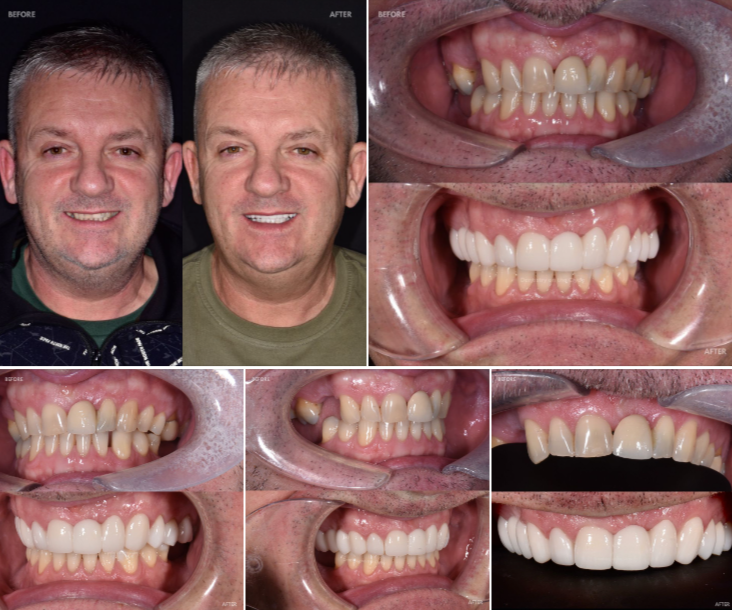 Dentistry On The Clyde | Dental Veneers Treatment done by dentist Nial
