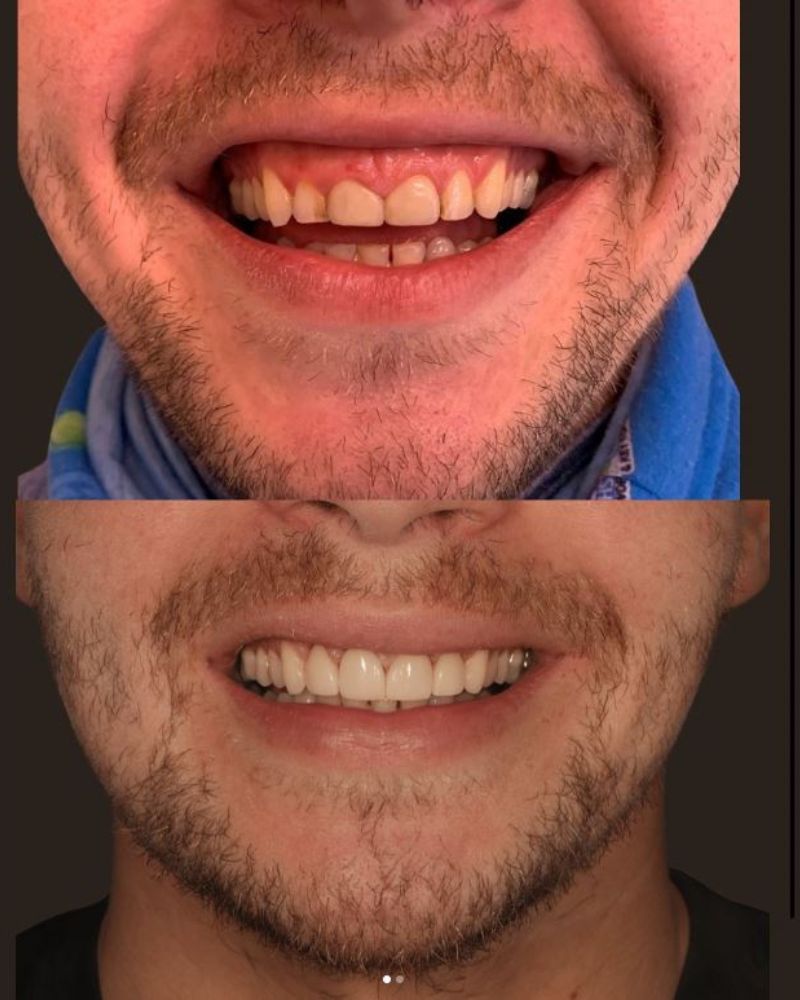 Before & after treatment with Morven
