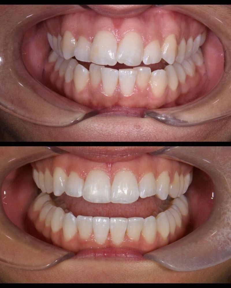 Before & after treatment with Nial