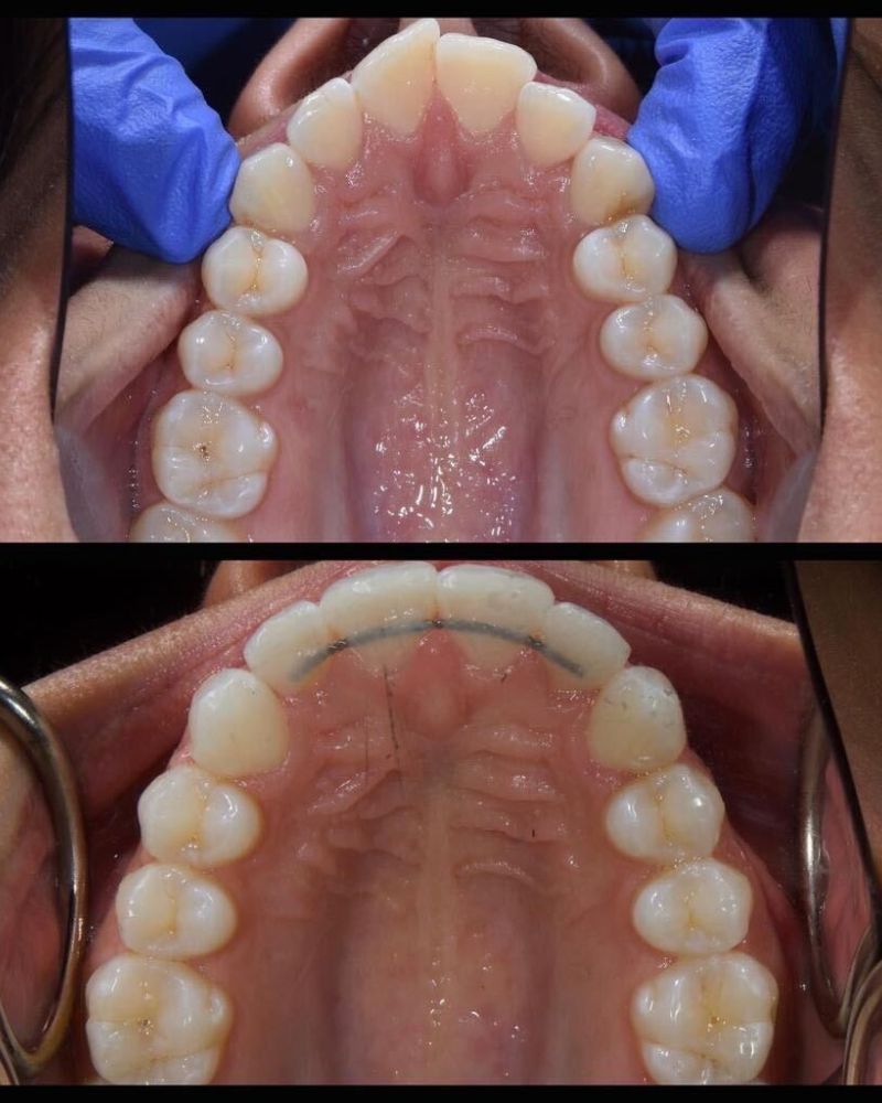 Before & after treatment with Nial