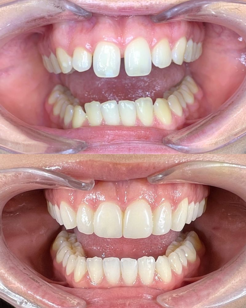 Before & after treatment with Ross