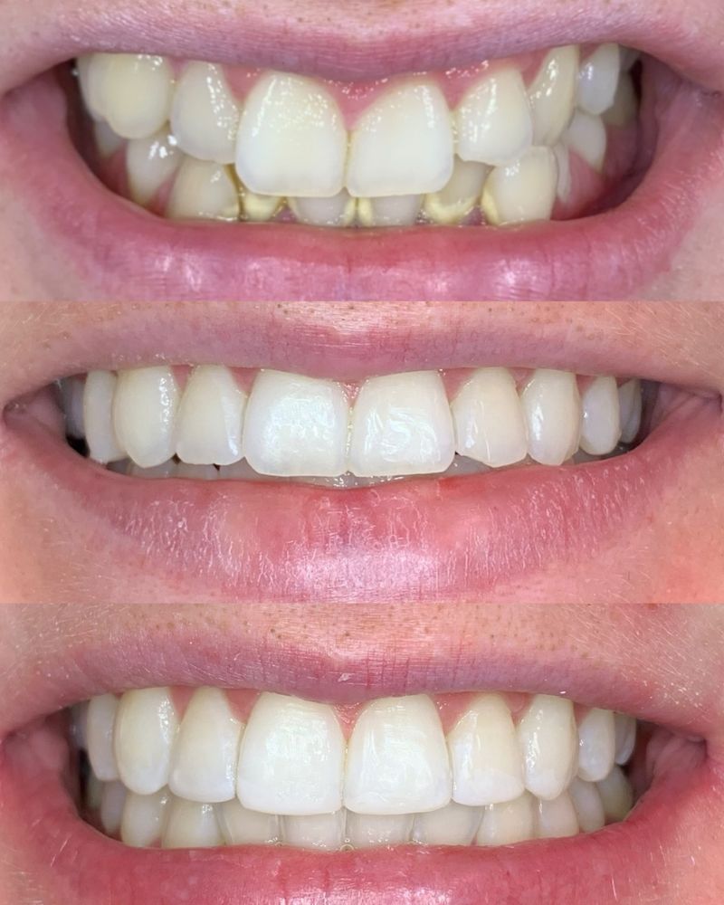 Before & after treatment with Ross
