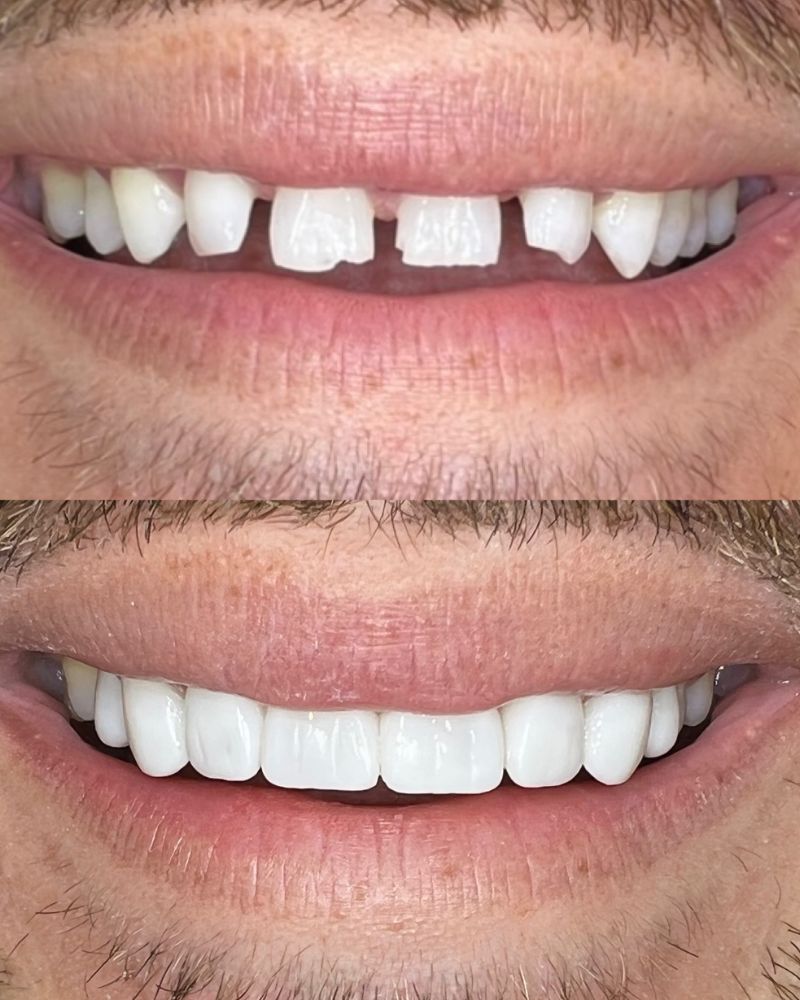 Before & after treatment with Ross