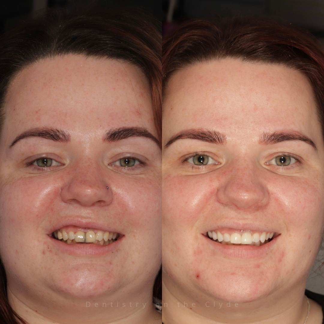 Before and after treatment