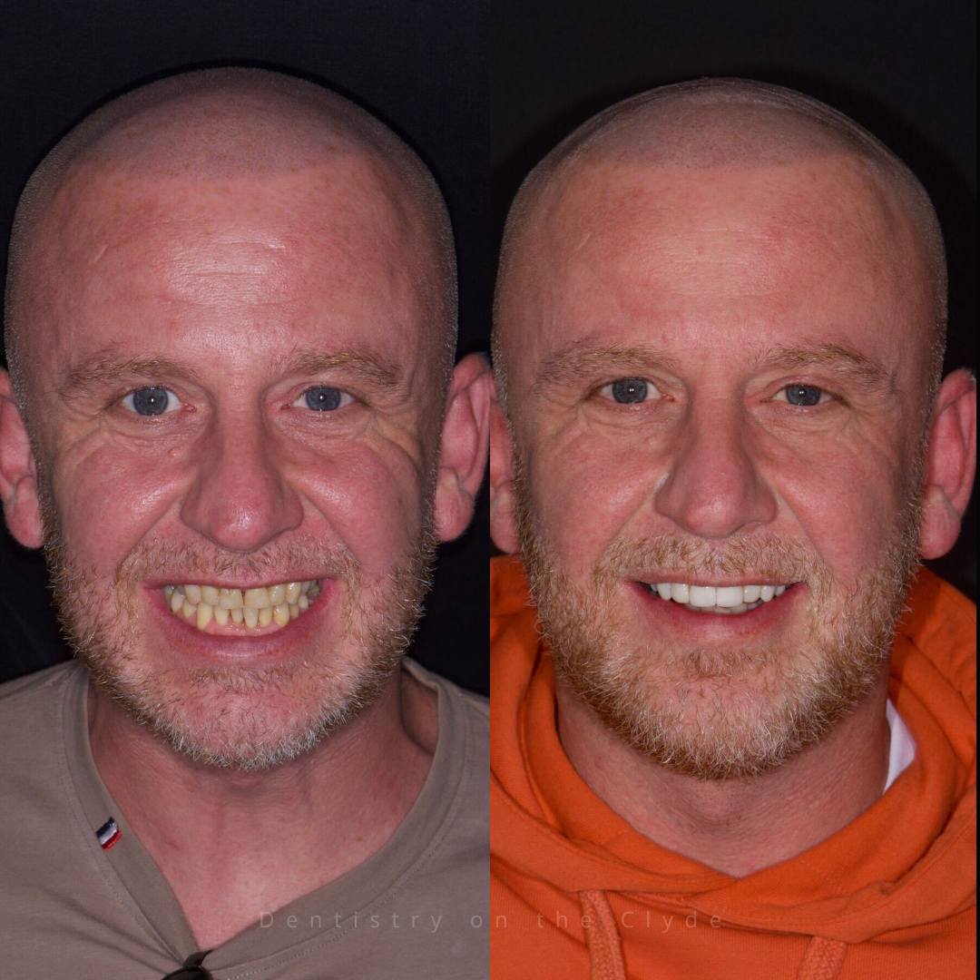 Before and after treatment