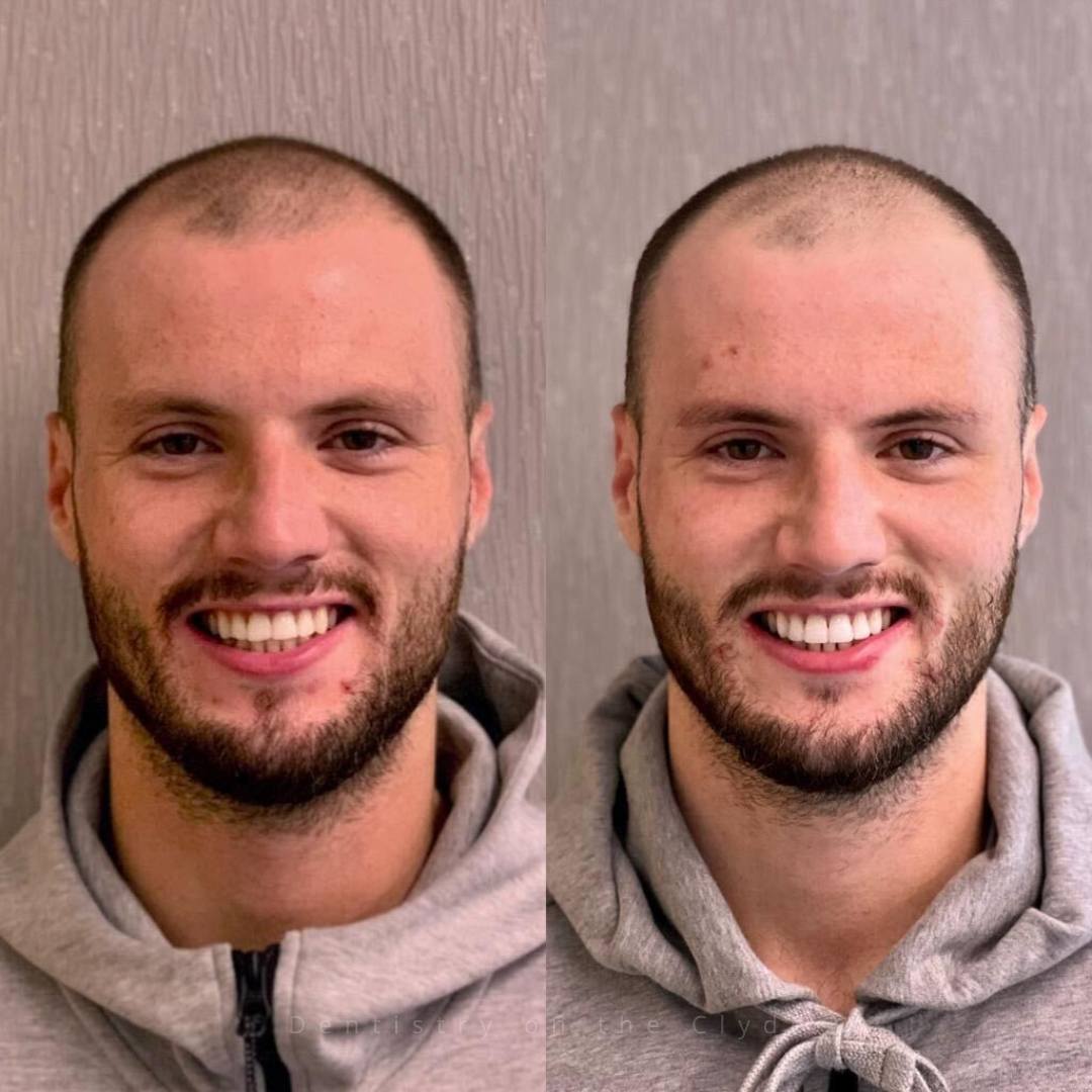 Before and after treatment