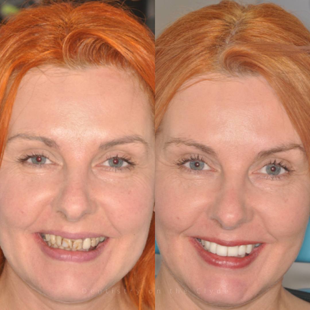 Before and after treatment