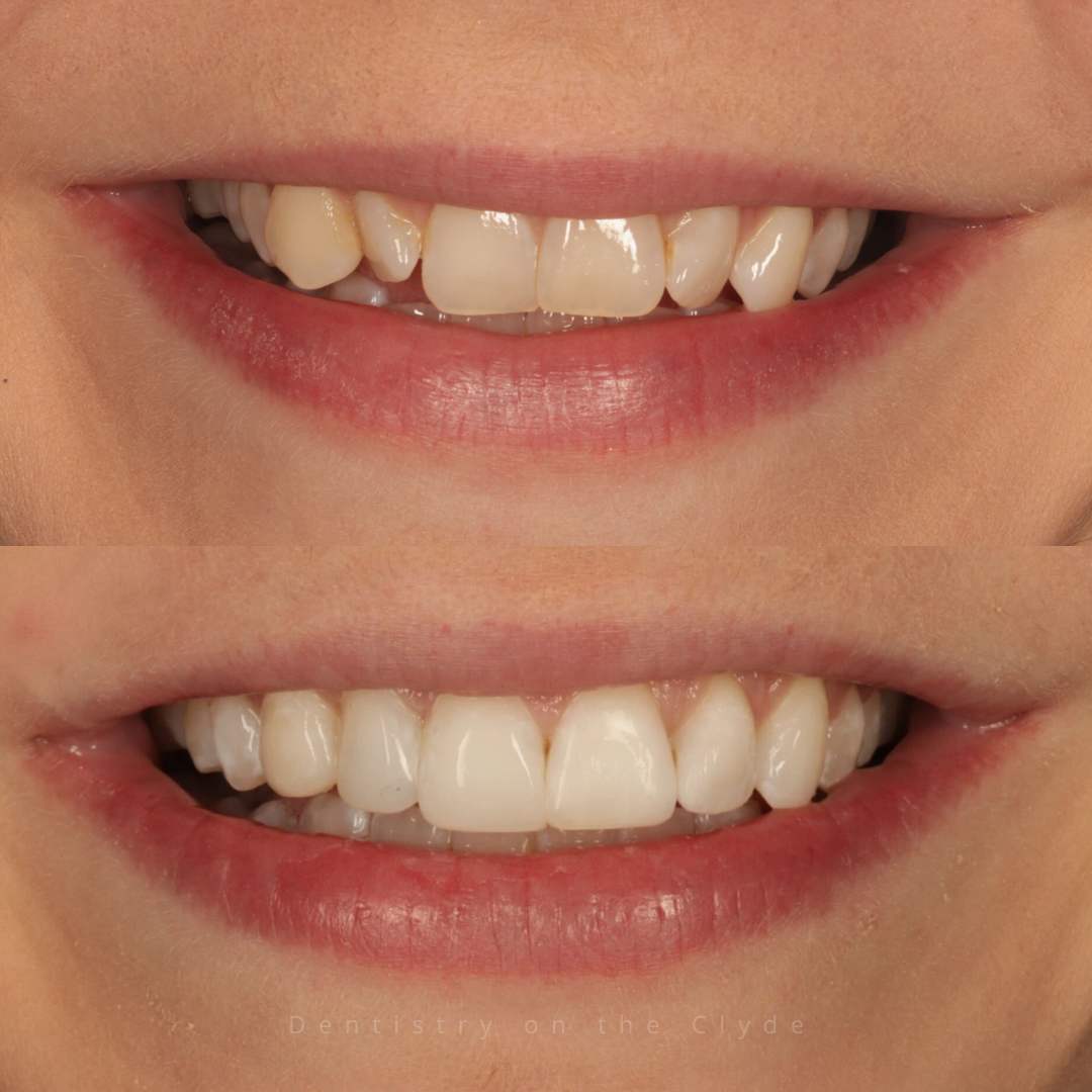 Before and after treatment at Dentistry On The Clyde in Gourock