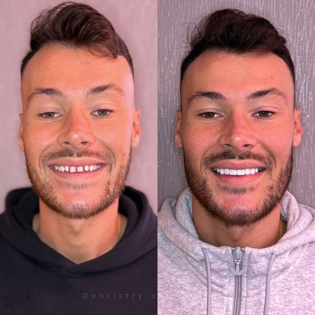 Before and after treatment
