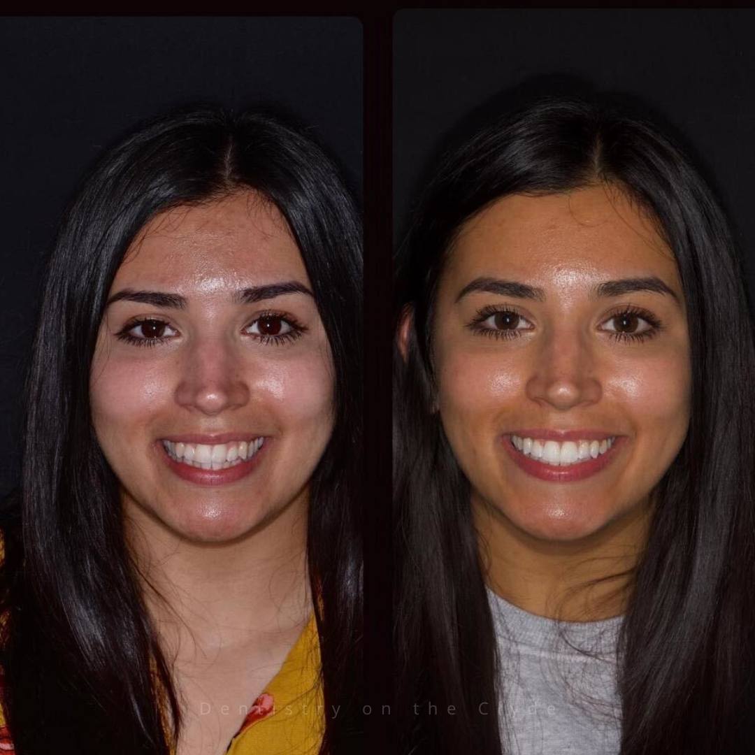 Before and after treatment