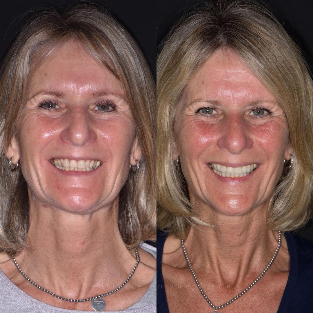 Before and after treatment