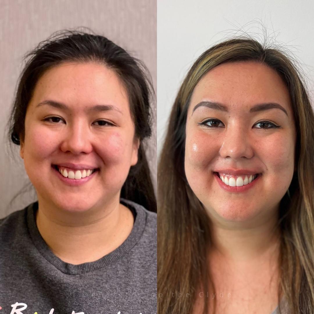 Before and after treatment