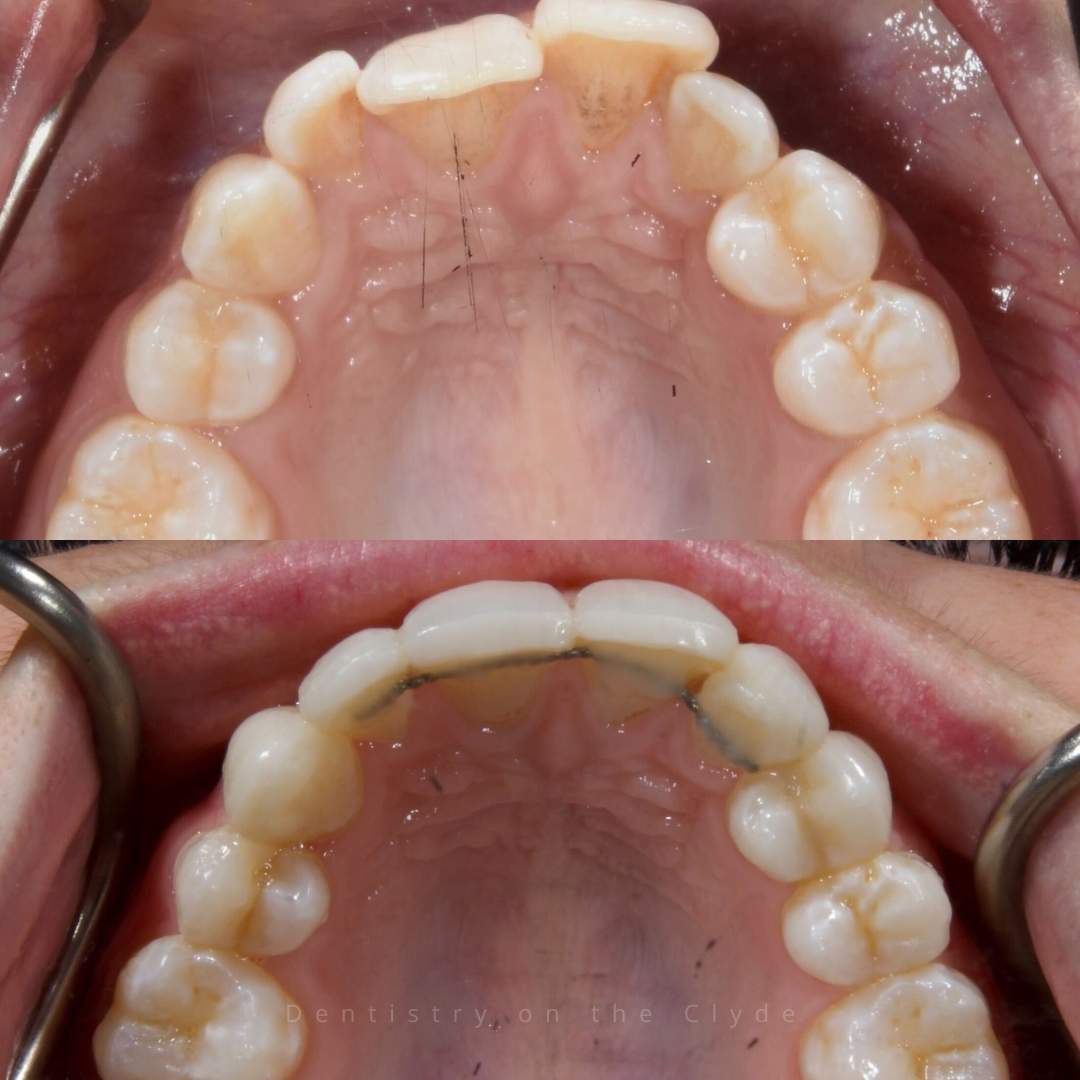 Before and after treatment at Dentistry On The Clyde in Gourock 