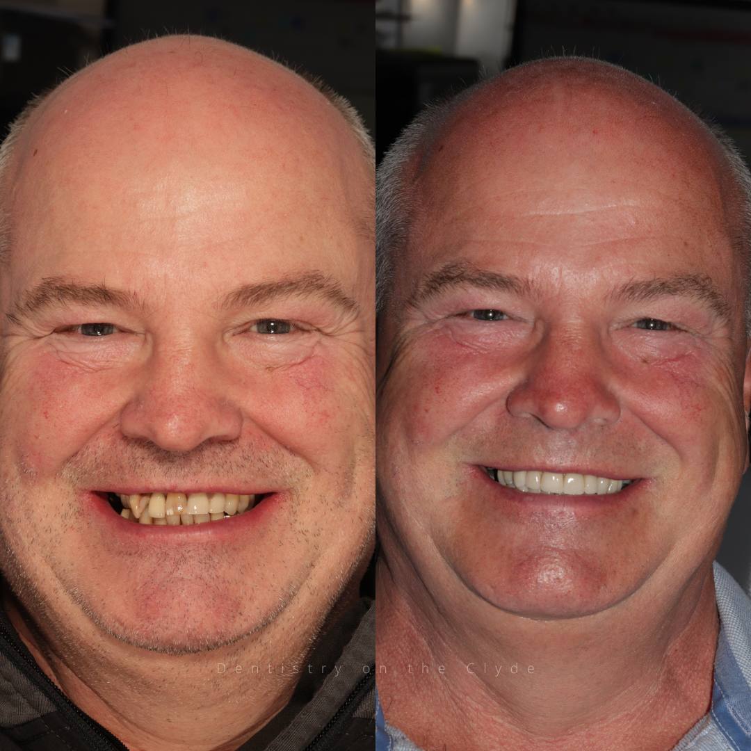 Before and after treatment