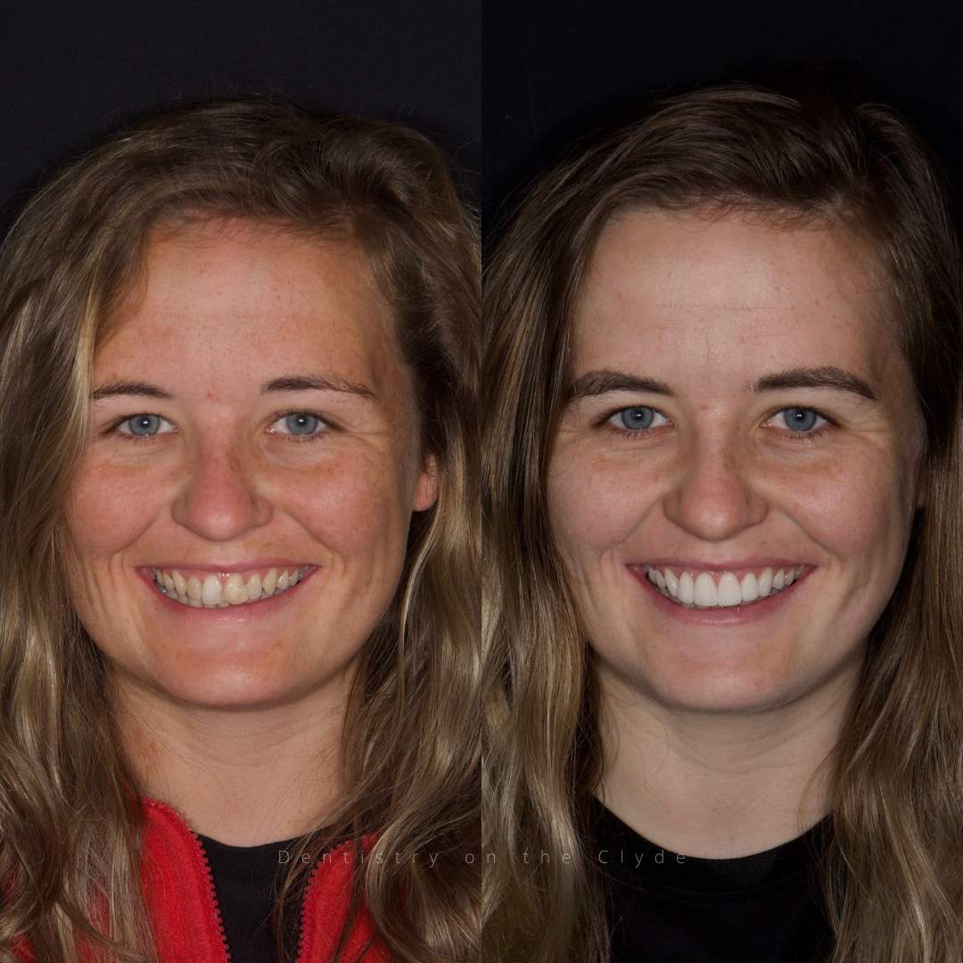 Before and after treatment
