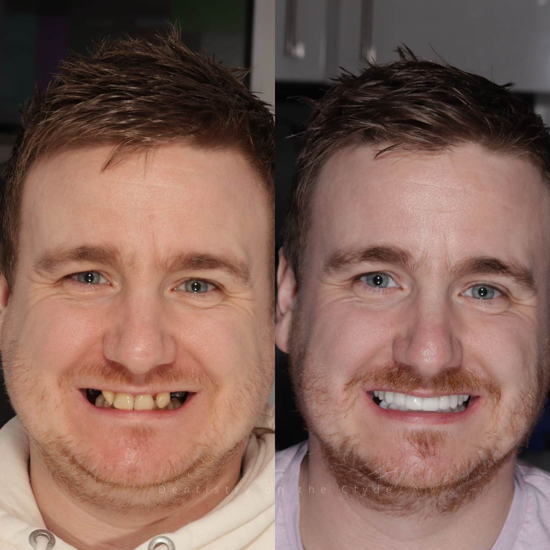 Before and after treatment