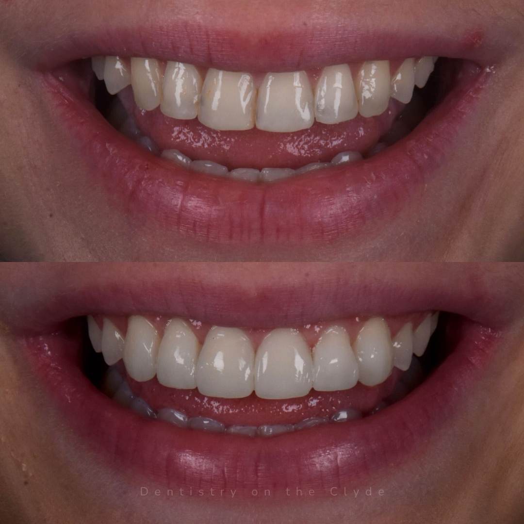 Teeth Whitening in Gourock