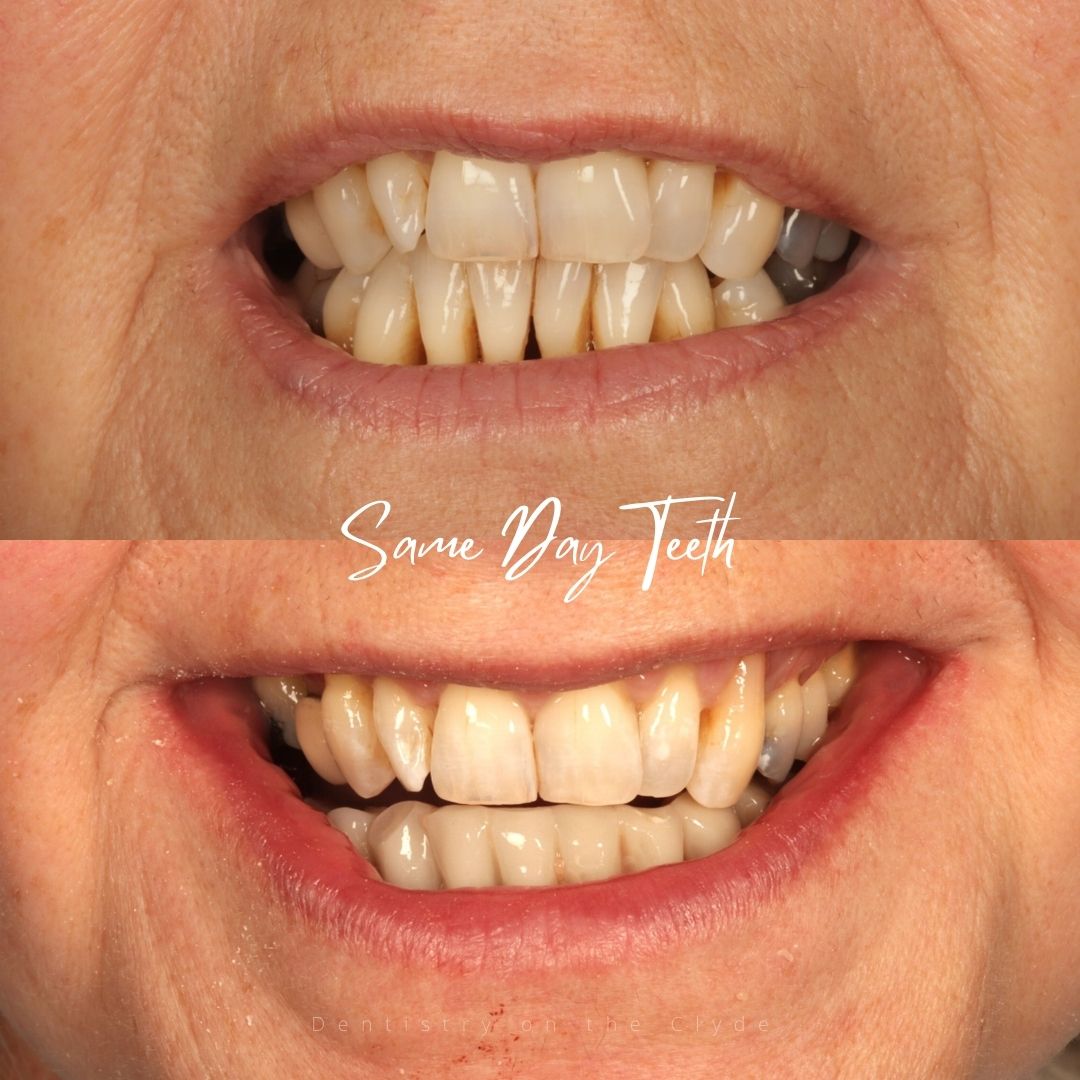 Dentistry On The Clyde | Dental Implants Gourock Replace Missing Teeth Dental Implants Treatment