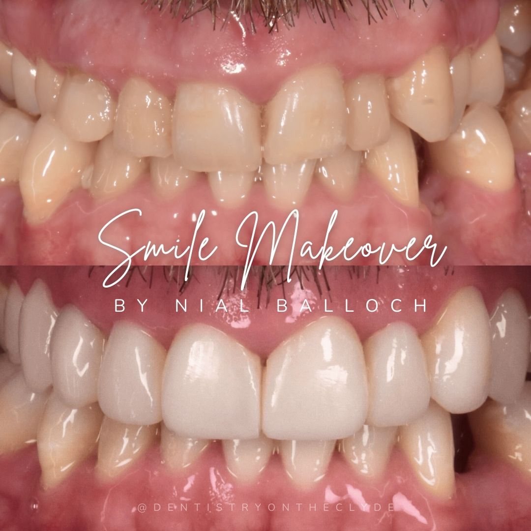 Before and after treatment at Dentistry On The Clyde in Gourock