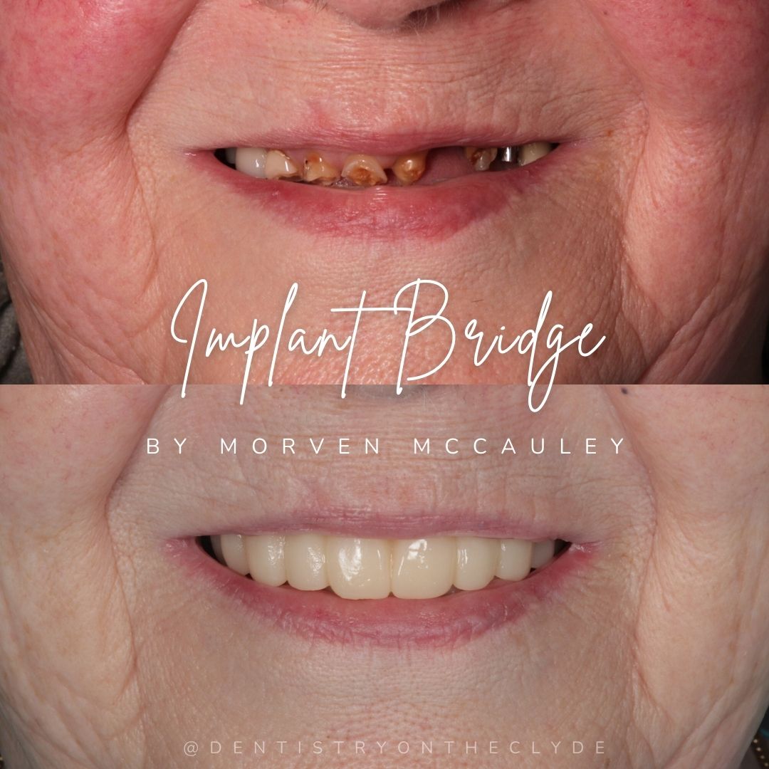 Before and after treatment at Dentistry On The Clyde in Gourock