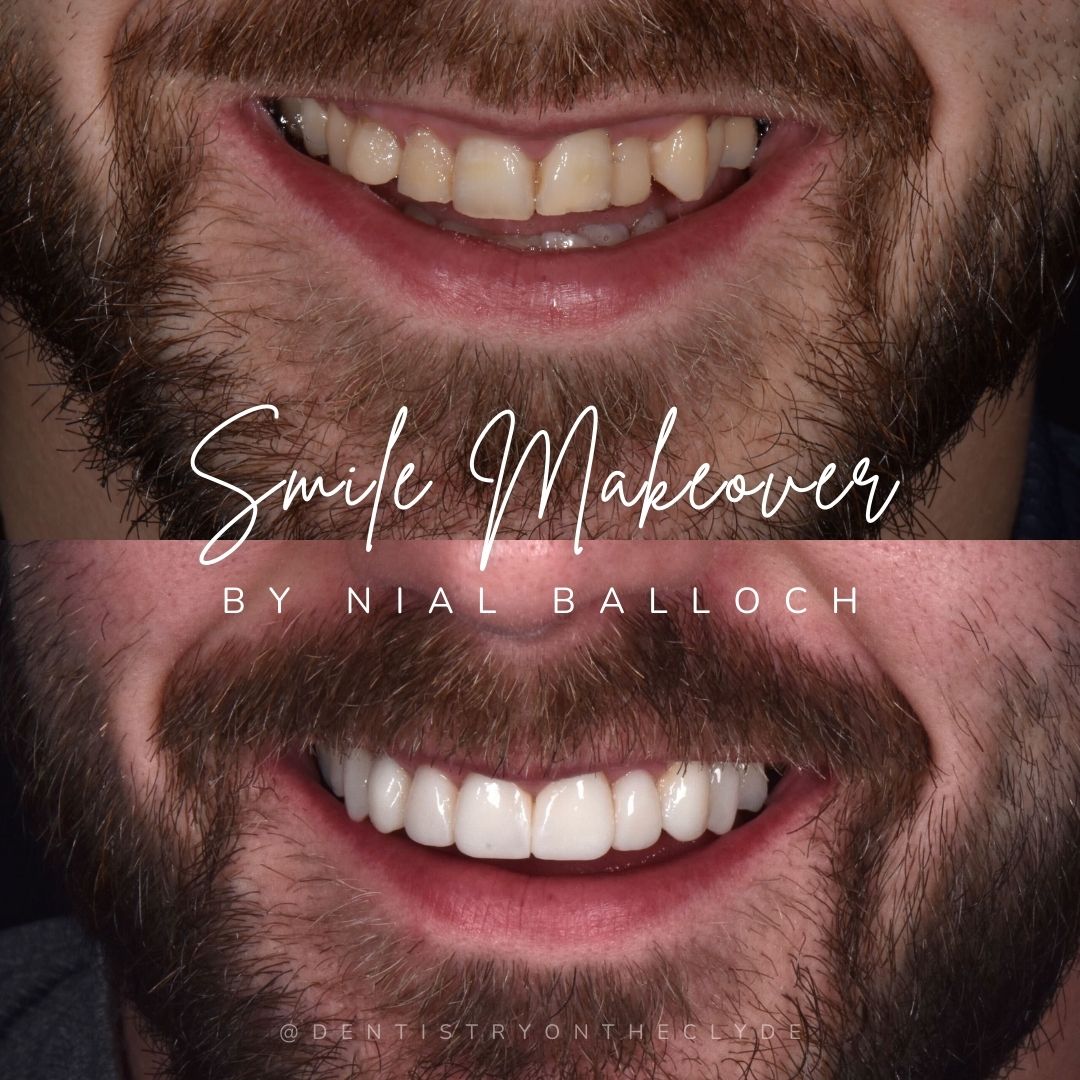 Before and after treatment at Dentistry On The Clyde in Gourock
