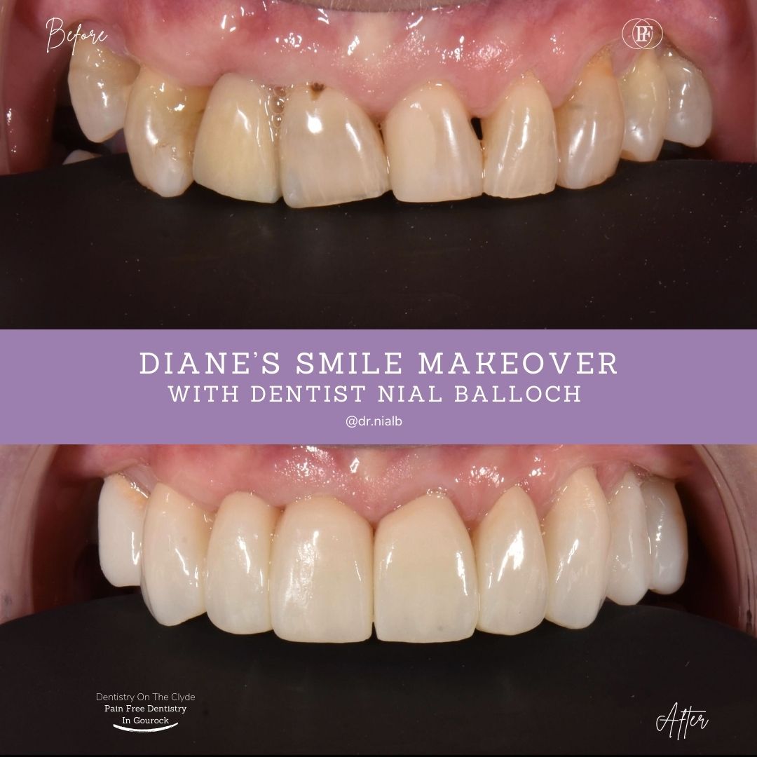 Dentistry On The Clyde | Diane's Smile Story