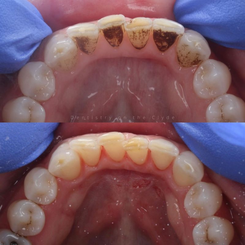 Before & after treatment with Thurga