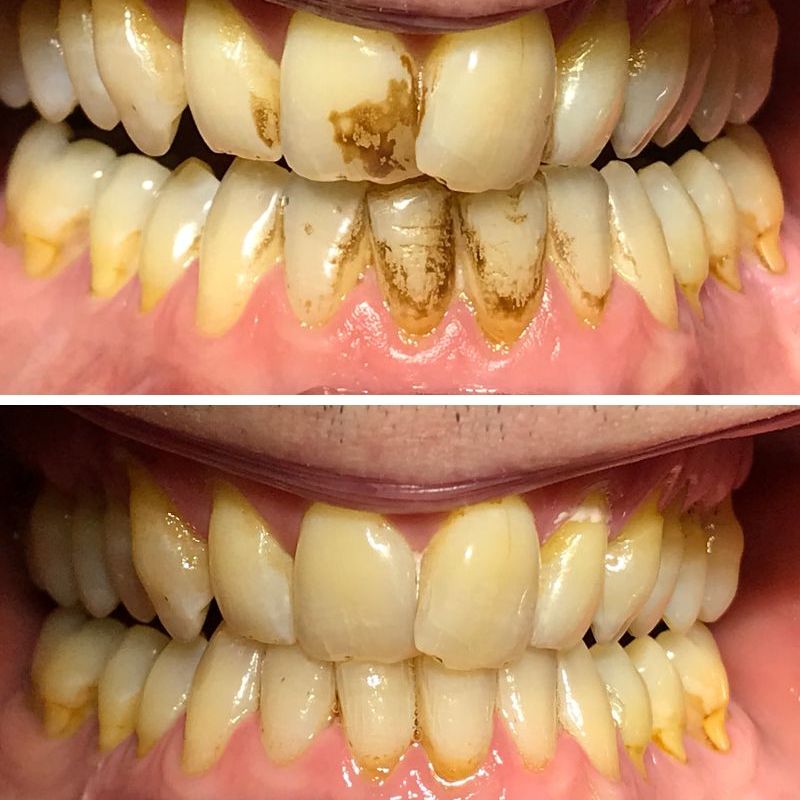 Before & after treatment with Thurga